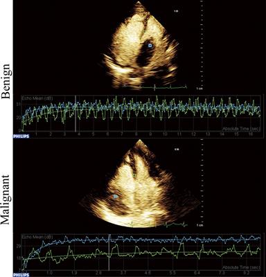 Contrast-enhanced echocardiographic diagnosis of benign and malignant cardiac tumors and its correlation with pathology
